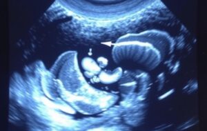 Au cœur de l'examen de mi‑grossesse : comprendre l'échographie morphologique