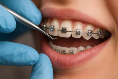 Металлические самолигирующие брекеты: как проходит установка и что важно знать до приёма